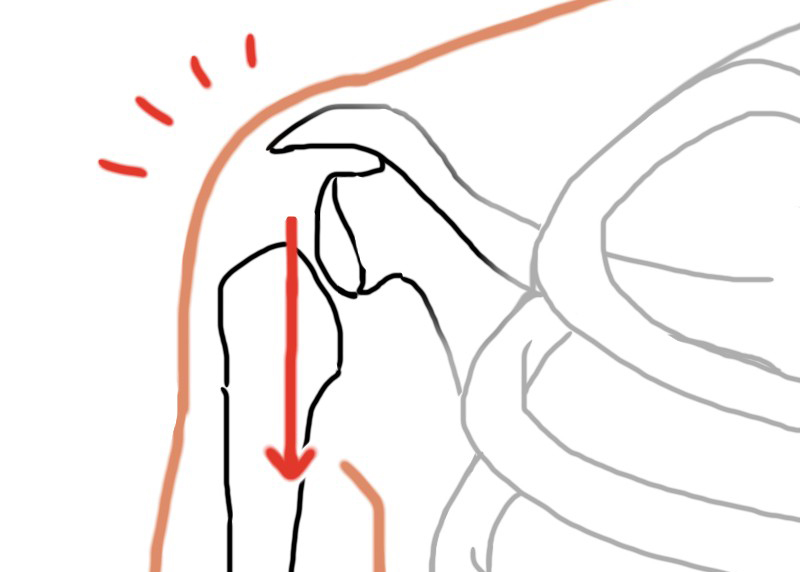 亜脱臼のイラスト